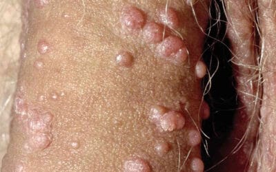 Ulasan: Lelaki Muda Hidap Penyakit STD di Malaysia Meningkat